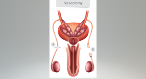 Vasectomia