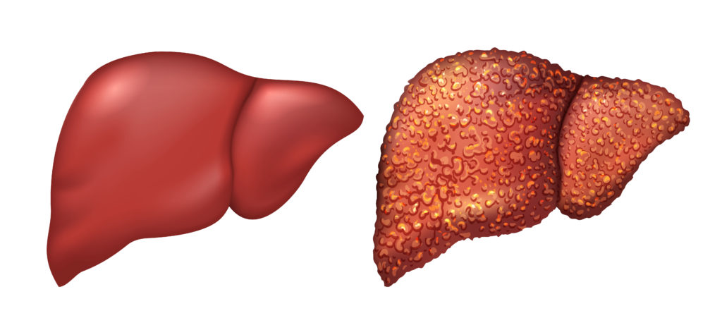 Hepatite-Fígado-Saudável-Fígado-Doente