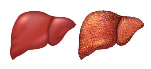 Hepatite-Fígado-Saudável-Fígado-Doente